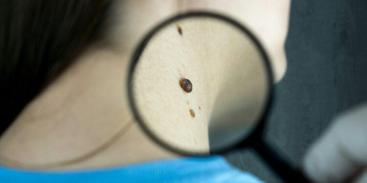 Nowoczesna technologia kontra rak skóry – USK Wrocław stawia na AI w diagnostyce